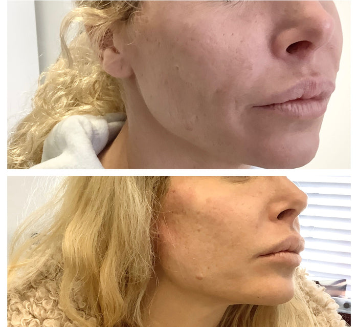Thread Lift Consultation