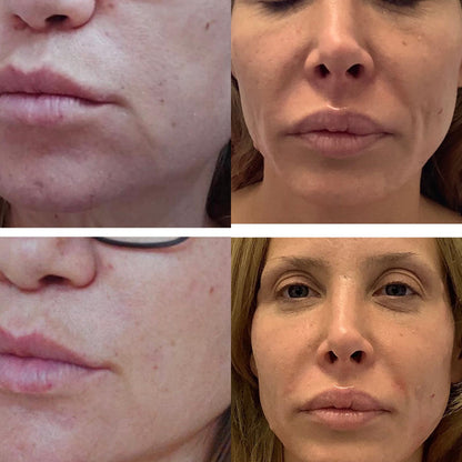 Thread Lift Consultation